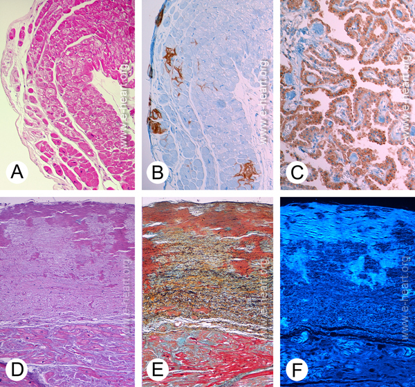 Endocardial amyloid microscopy